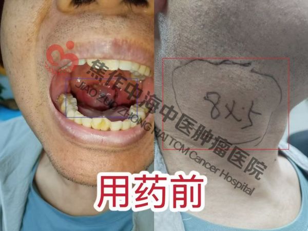 淋巴瘤王泽领3.jpg