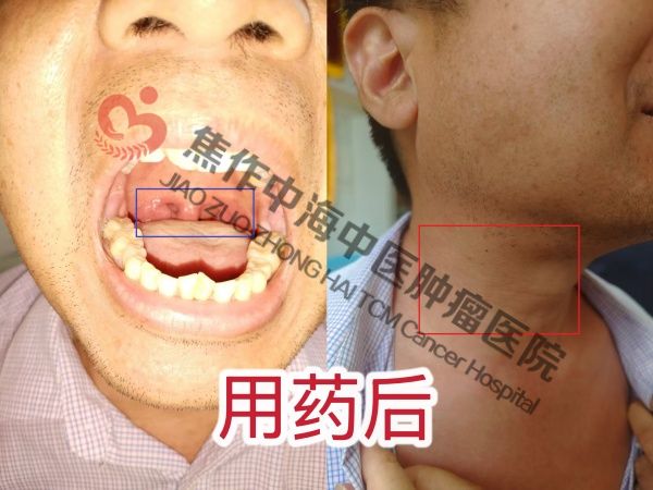 淋巴瘤王泽领4.jpg
