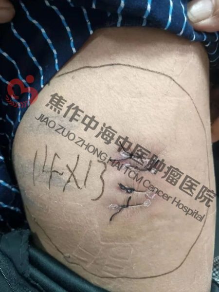 肉瘤刘大爷1.jpg