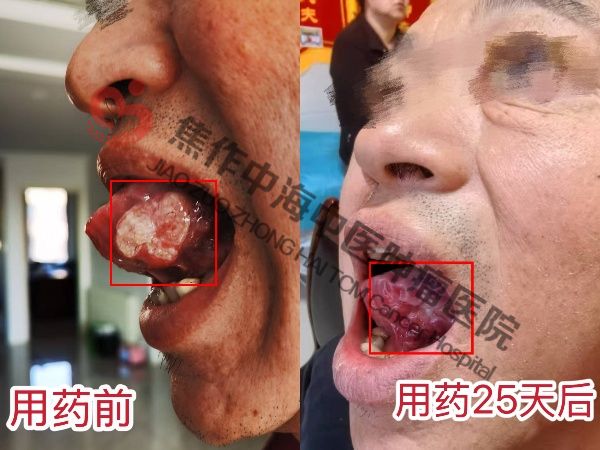 舌癌杨林5.jpg