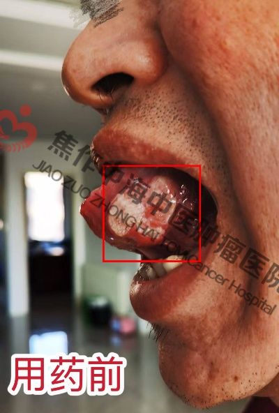 1758528927833835.jpg 舌癌杨林2.jpg