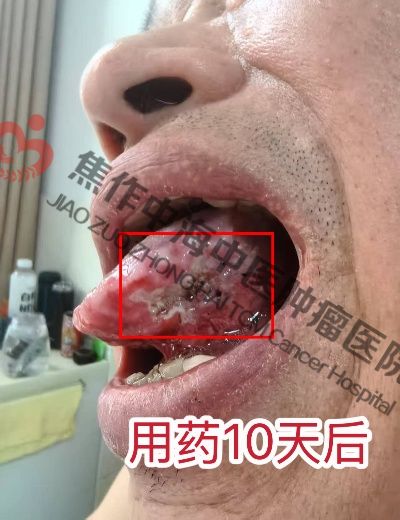 1758528954731454.jpg 舌癌杨林3.jpg