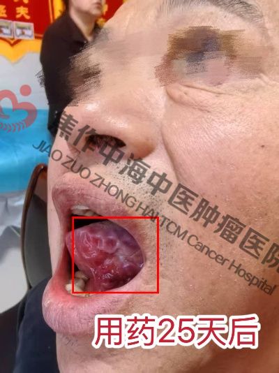 1758528976454689.jpg 舌癌杨林4.jpg