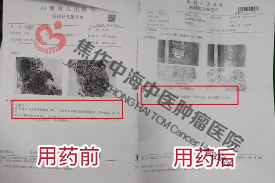 胃癌宋学丽.jpg