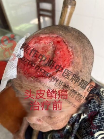 头皮癌萧秀珍2.jpg