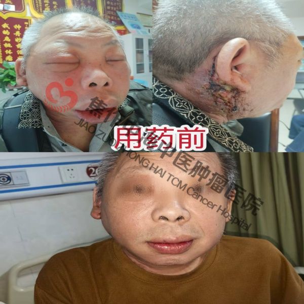 腮腺癌陈友生.jpg