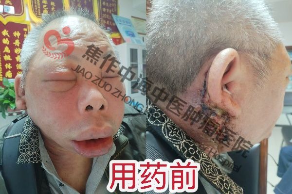 1761034321656172.jpg 腮腺癌陈友生2.jpg