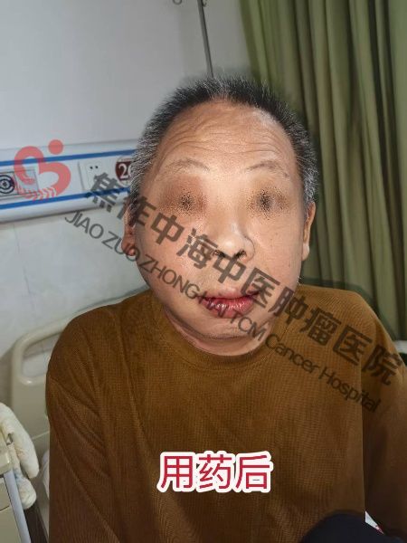 1761034336706358.jpg 腮腺癌陈友生3.jpg