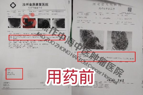 1761642116428231.jpg 胃癌宋学丽1.jpg