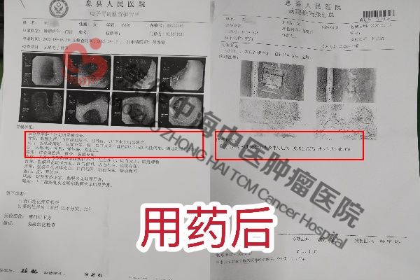 1761642137528709.jpg 胃癌宋学丽2.jpg