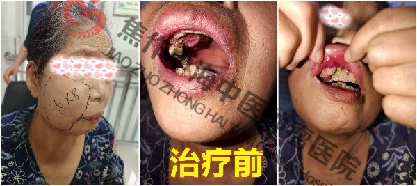 1762329411229693.jpg 牙龈癌陈慧芳2.jpg