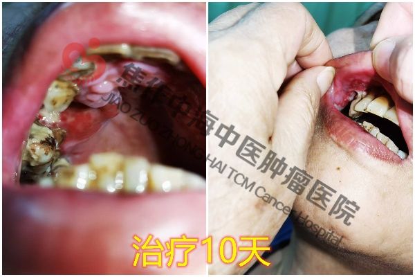 1762329434954883.jpg 牙龈癌陈慧芳3.jpg