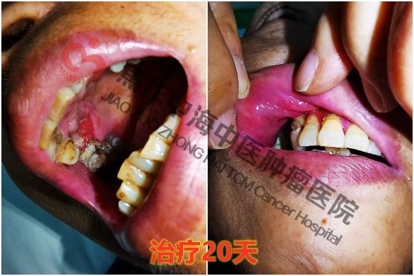 1762329454544693.jpg 牙龈癌陈慧芳4.jpg