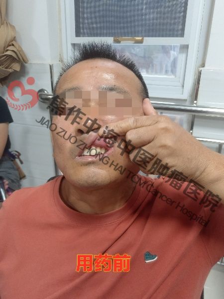 1762330514952166.jpg 舌癌刘列金1.jpg