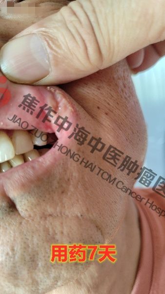 1762330663962864.jpg 舌癌刘列金2.jpg