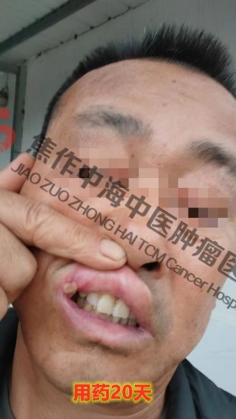 1762330690431488.jpg 舌癌刘列金3.jpg