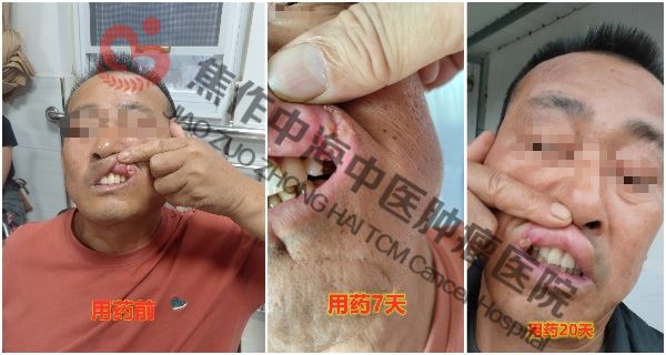 1762330708692957.jpg 舌癌刘列金4.jpg