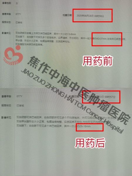 1763019769579676.jpg 淋巴瘤李秀花.jpg