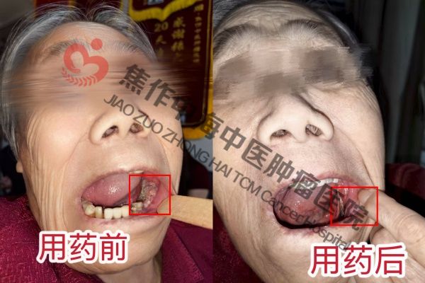 牙龈癌李玉梅.jpg