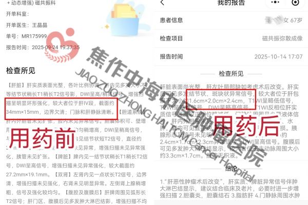 1765004444459514.jpg 肝癌郭学爱.jpg