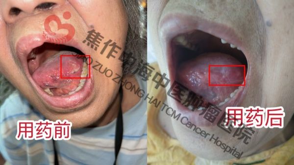 舌癌赵迎新.jpg