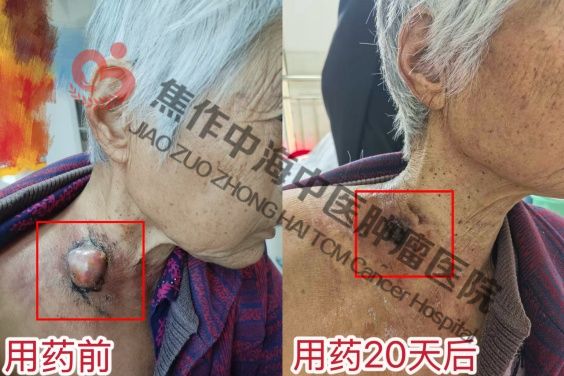 1769050236763933.jpg 肺癌樊桂英1.jpg