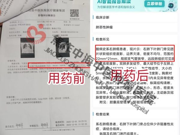 1773218725555510.jpg 肺癌姜云飞.jpg