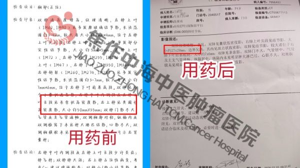 1773298730683520.jpg 肺癌丁明忠.jpg