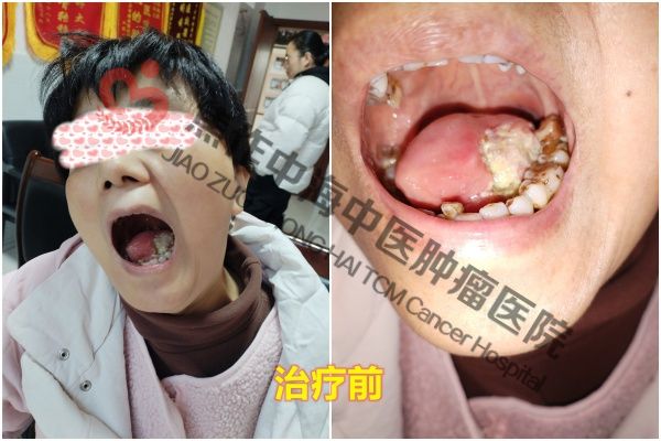 1773975965404839.jpg 舌癌姚红英2.jpg