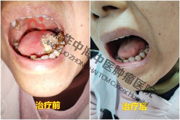 1773976038332770.jpg 舌癌姚红英3.jpg