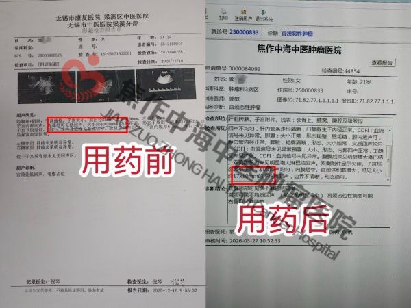 1775034247666723.jpg 宫颈癌郭亚娟.jpg