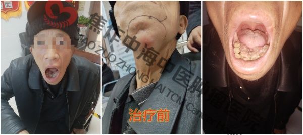 牙龈癌龙文程2.jpg