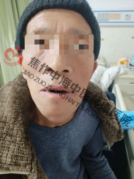 牙龈癌龙文程3.jpg