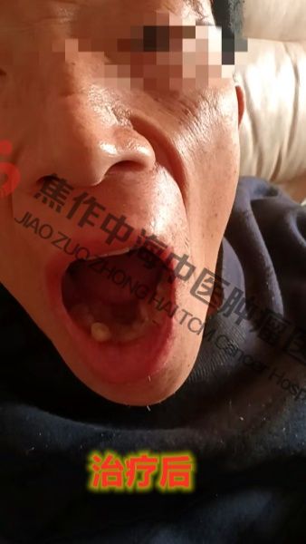 牙龈癌龙文程4.jpg