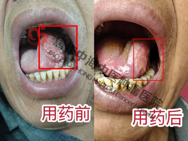 舌癌李祥庆.jpg