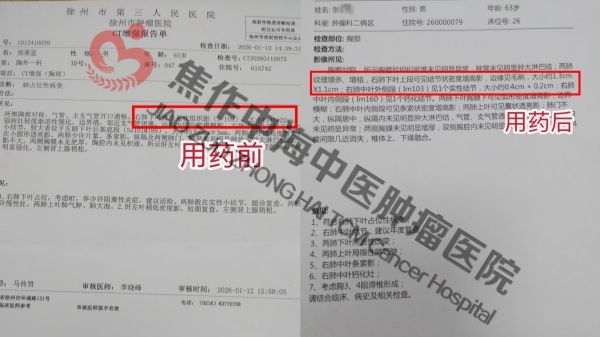 肺癌张荣堂.jpg