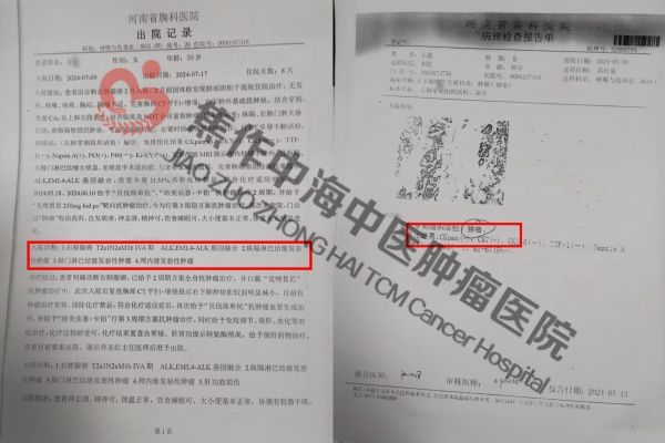肺癌王趁1.jpg