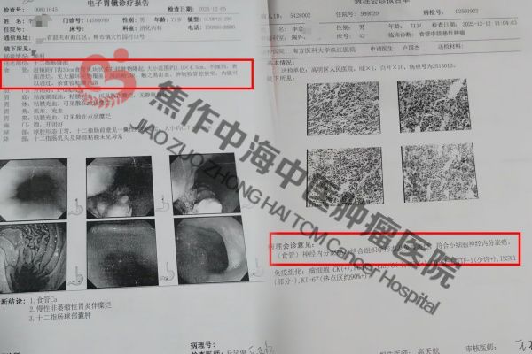 1780998515225544.jpg 食道癌李金兴1.jpg
