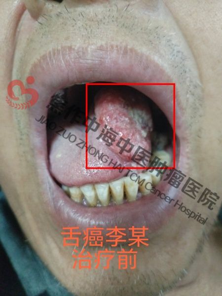 1780998925678225.jpg 舌癌李祥庆2.jpg