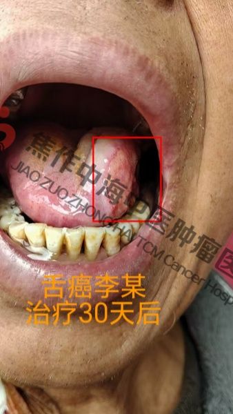 1780998949188684.jpg 舌癌李祥庆3.jpg