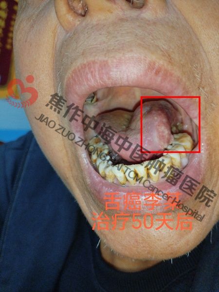 1780998972878936.jpg 舌癌李祥庆4.jpg