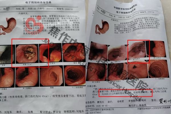 贲门癌杨根旺.jpg