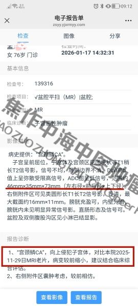 宫颈癌孟凡英3.jpg