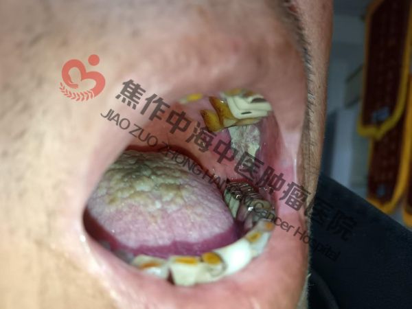 1782786146975170.jpg 扁桃体癌丁会芳1.jpg