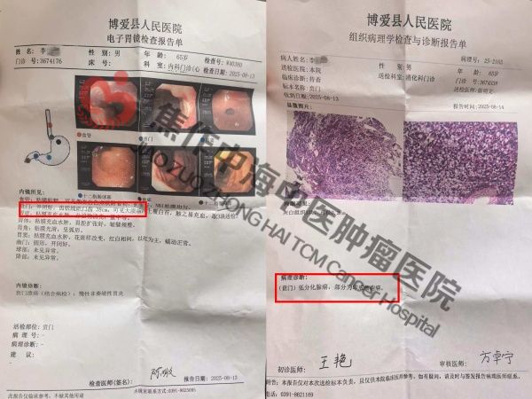1783654157488834.jpg 贲门癌李炳新1.jpg