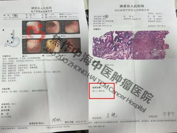 1783654194192227.jpg 贲门癌李炳新2.jpg