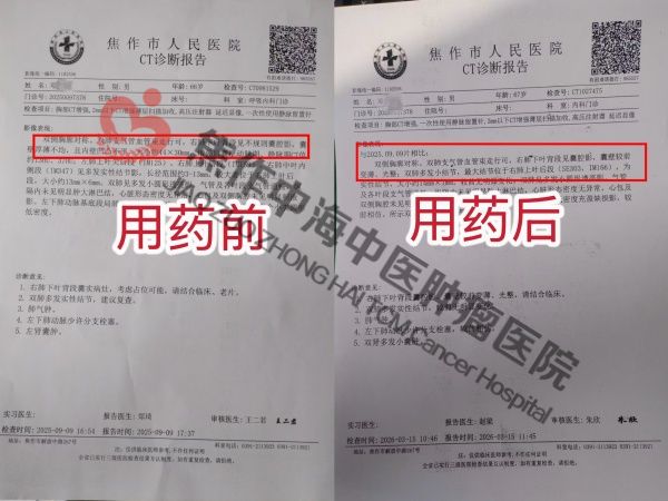 肺癌邓孟柏2.jpg