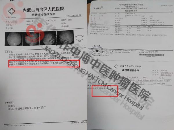 1785204678850723.jpg 膀胱癌王占悦1.jpg