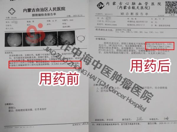 1785204695459235.jpg 膀胱癌王占悦2.jpg