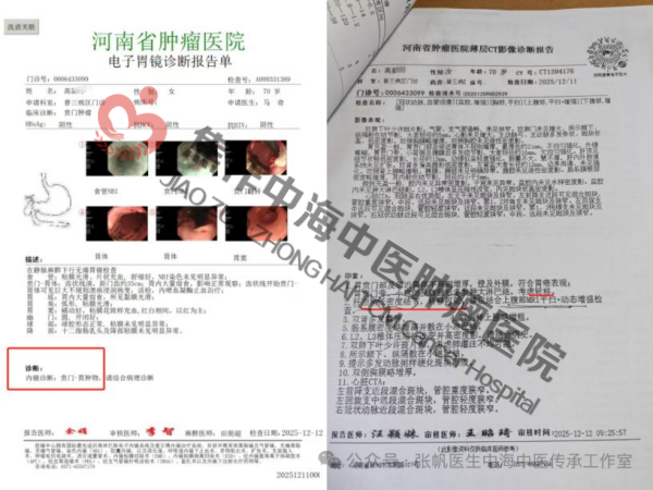 贲门癌高新玲1.png